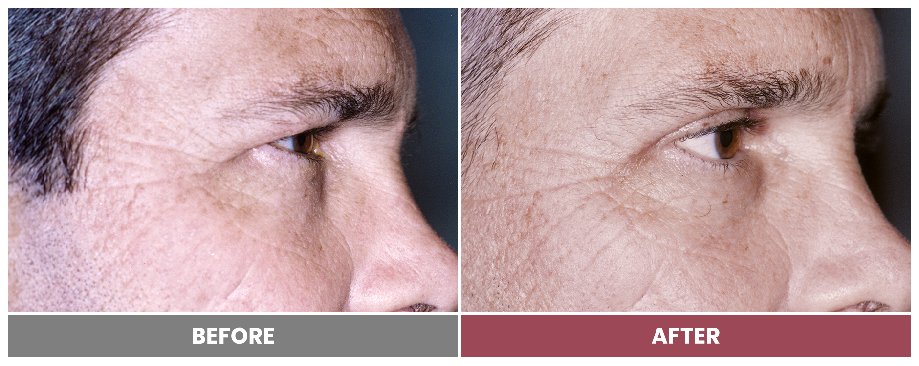 Upper Blepharoplasty - Case 17